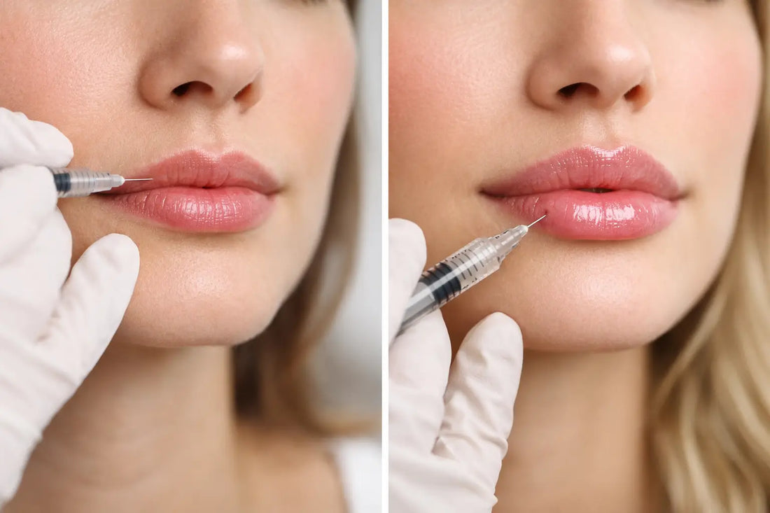 Lip Flip vs Filler: Which Looks More Natural?