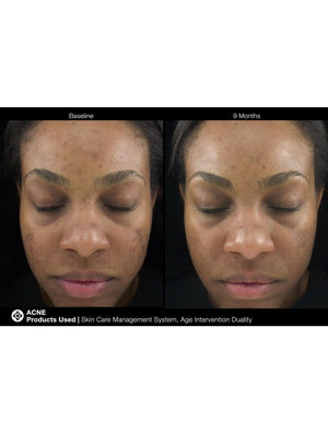 Jan Marini Age Intervention Duality cream in jar, designed to target dark spots on skin.