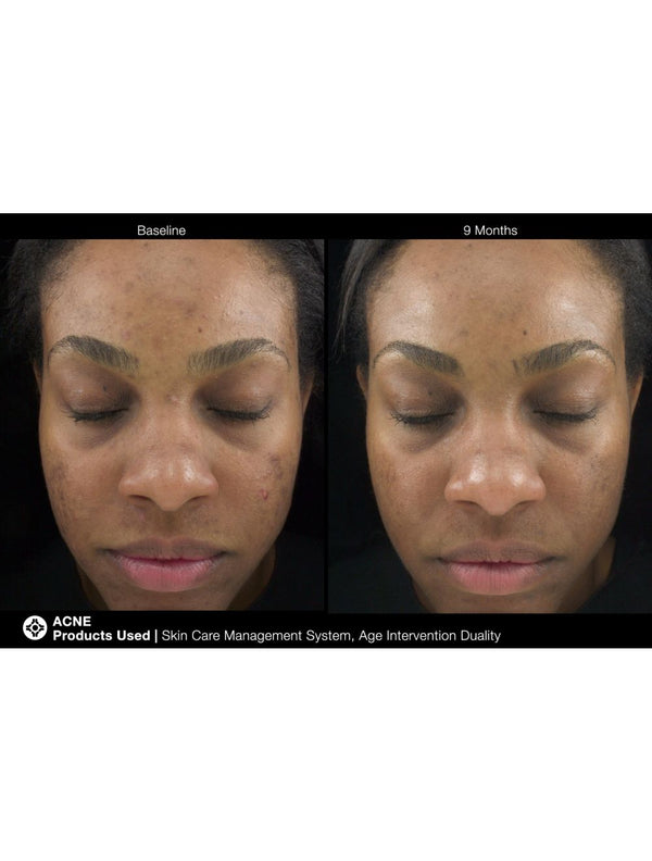 Jan Marini Age Intervention Duality cream in jar, designed to target dark spots on skin.