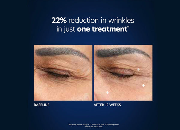 PCA Skin Hyaluronic Acid Microneedle Eye Patches in packaging, designed to reduce fine lines and wrinkles around the eyes.