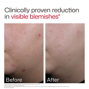 EltaMD UV Clear Blemish-Prone & Oil Balancing SPF 50 product image 7