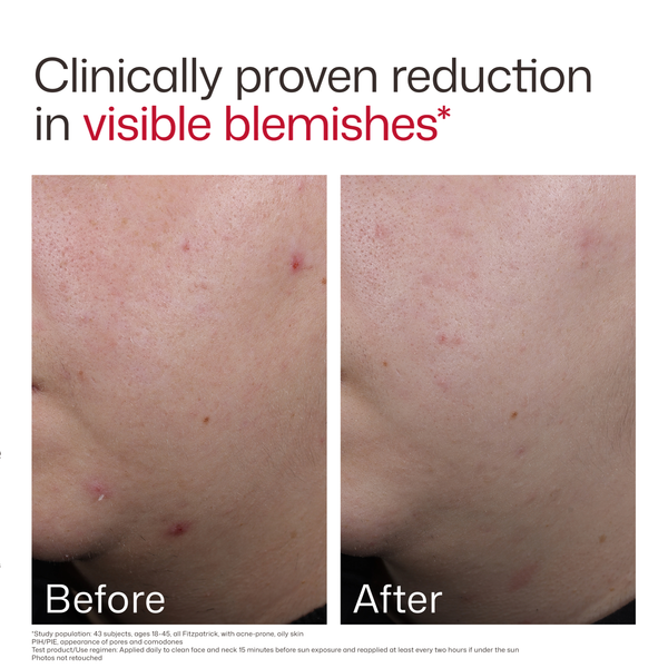 EltaMD UV Clear Blemish-Prone & Oil Balancing SPF 50 product image 7
