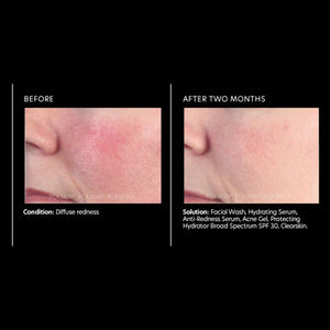 PCA Skin Anti-Redness Serum 1 oz - European Beauty by B