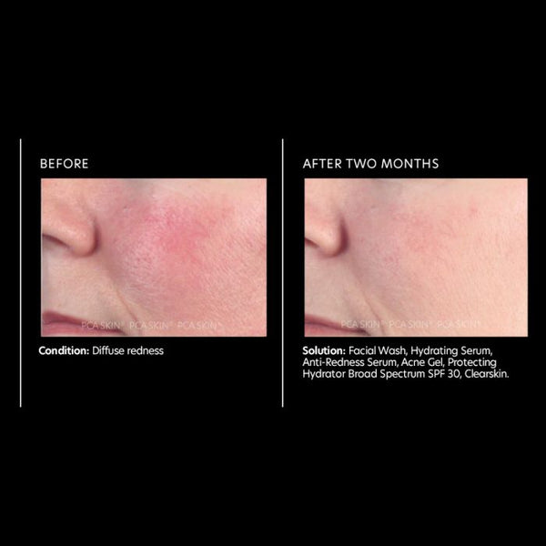 PCA Skin Anti-Redness Serum 1 oz - European Beauty by B