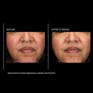 Before and after image of PCA Skin Resurfacing Serum showing reduced redness on skin. 1 fl oz serum bottle included.