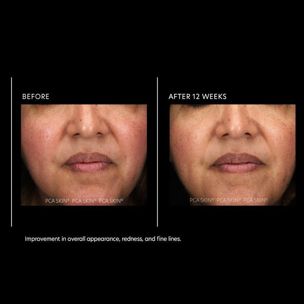 Before and after image of PCA Skin Resurfacing Serum showing reduced redness on skin. 1 fl oz serum bottle included.